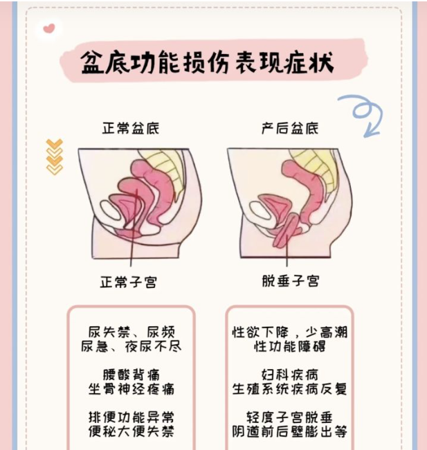 為什么要做產(chǎn)后盆底康復(fù)